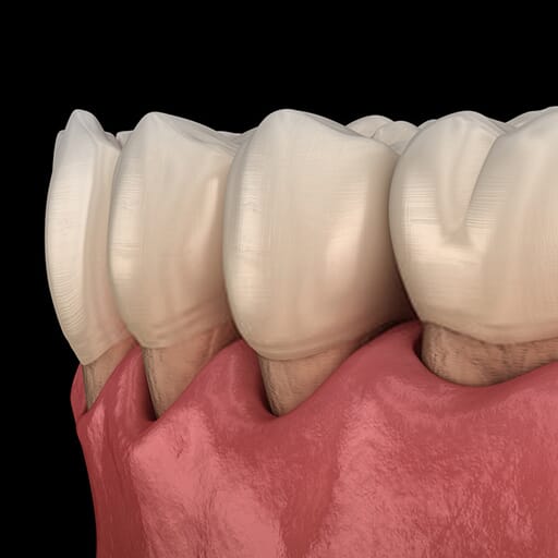 teeth_replacement_arrow_dental_nairobi_kenya