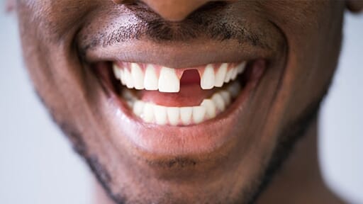 teeth_replacement_arrow_dental_nairobi_kenya